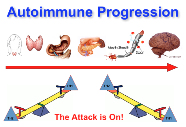 Autoimmune Progression