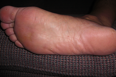 The Almost Wart-Free Foot