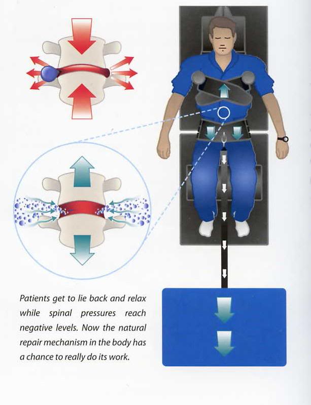 Spinal Decompression