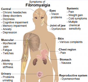 symptoms of fibromyalgia