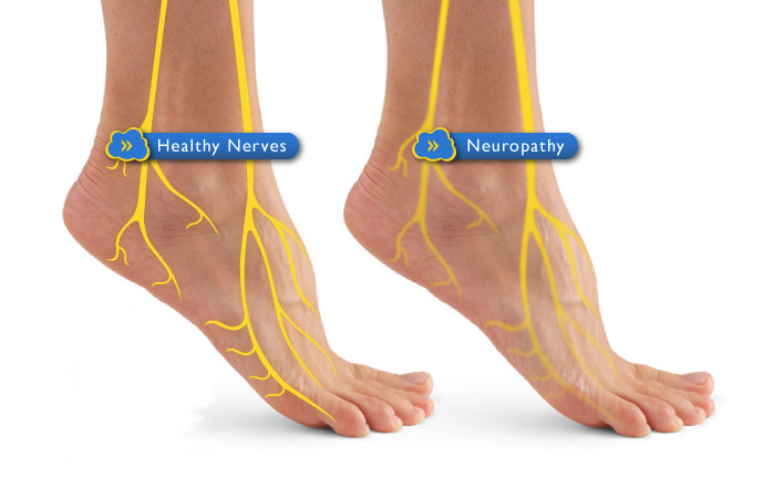 Нейропатия конечностей ног. Нейропатии большеберцового малоберцового нерва. Диабетическая нейропатия стопы. Периферический нерв стопы.