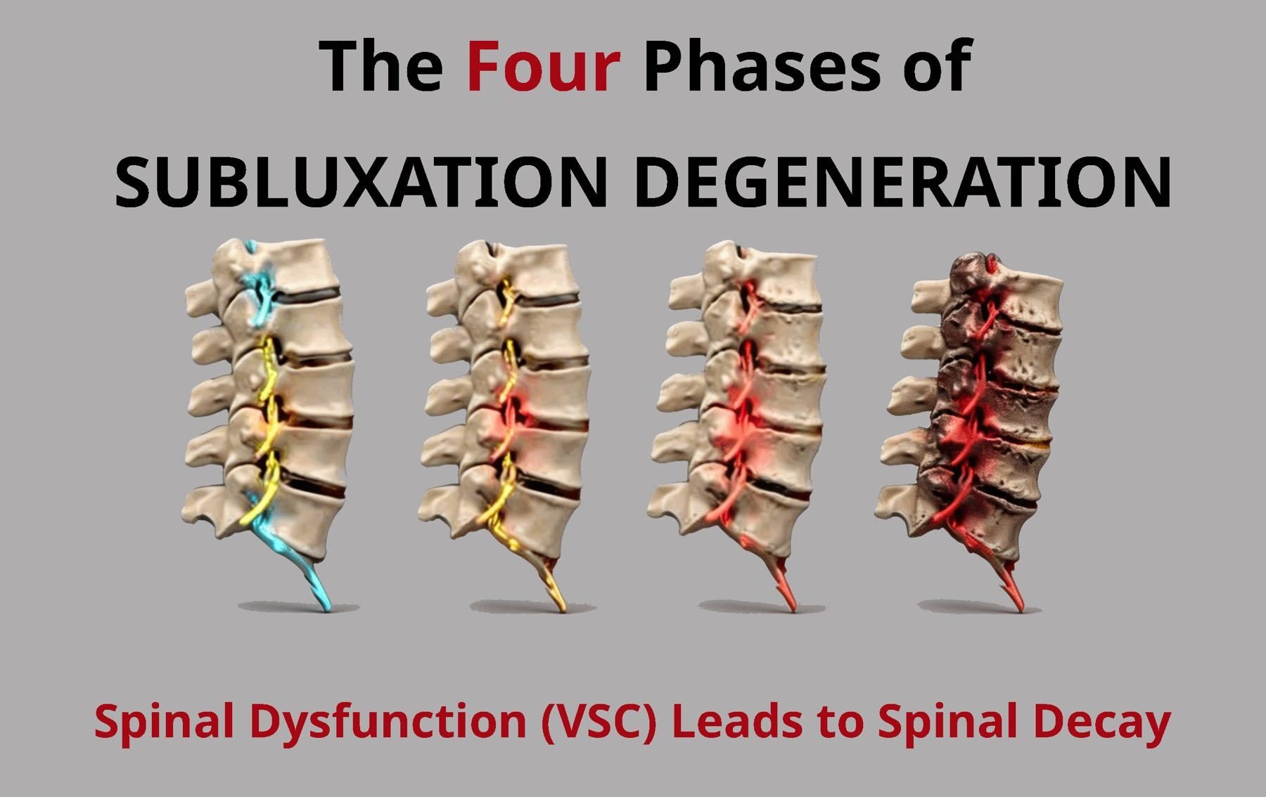 Phases of Spinal Degeneration_JCNN-1800