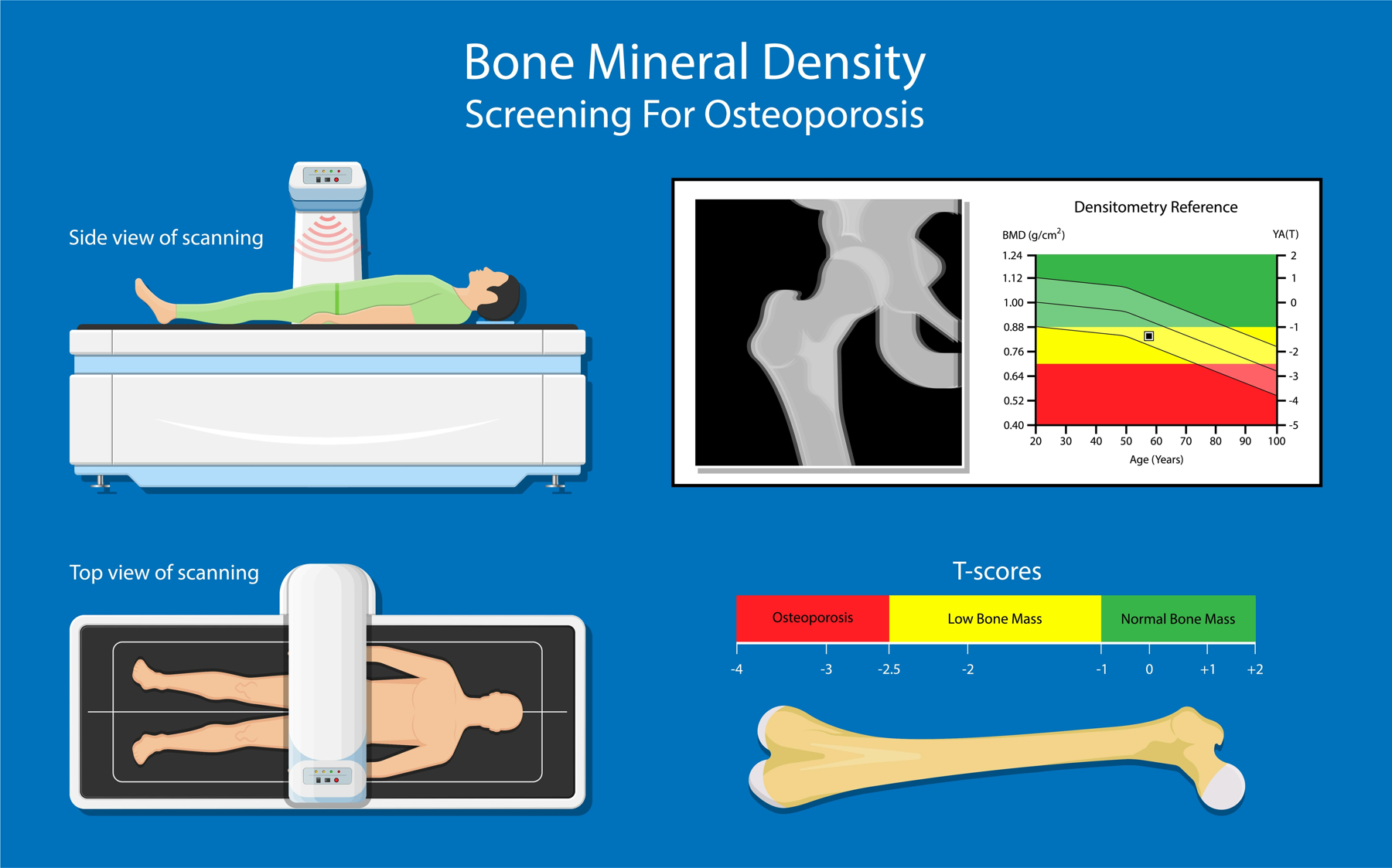 AdobeStock_Bone mineral density BMD osteoporosis dual energy X-ray absorptionmetry-1800