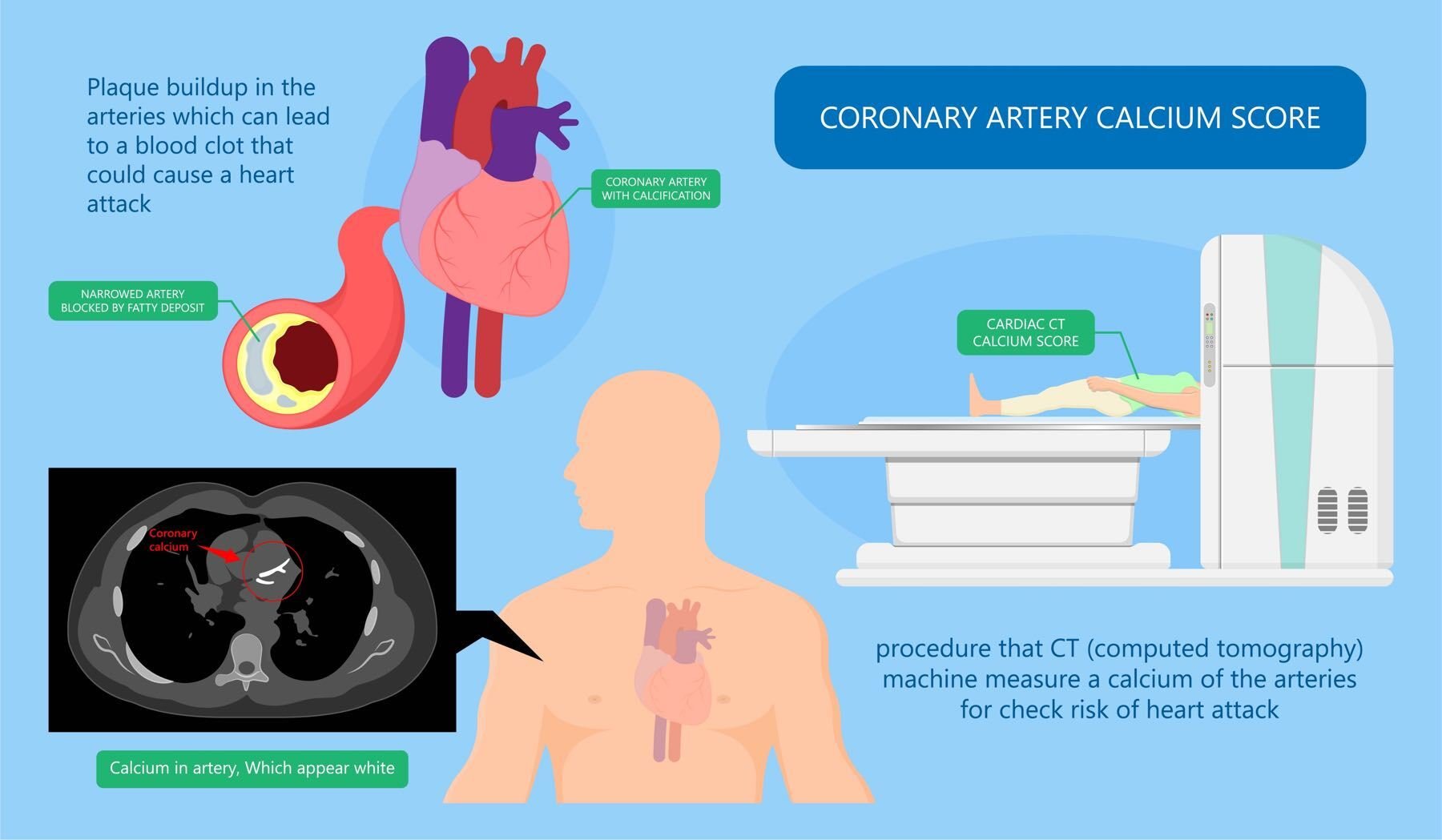 AdobeStock_Cardiac Calcium Scoring-1800