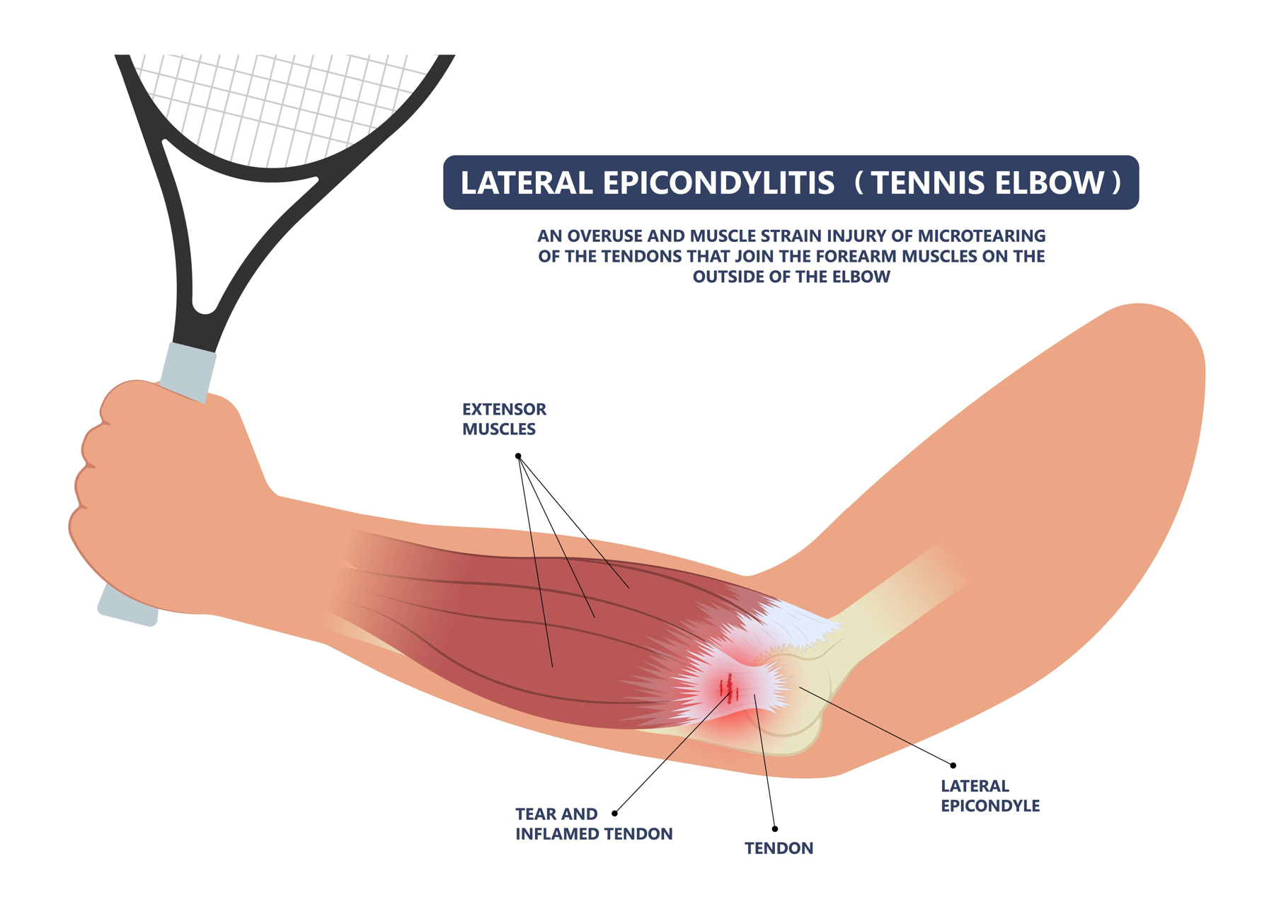 AdobeStock_Tennis Elbow Elbow Pain Lateral Epicondylitis