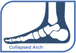 Collapsed-Arch-Foot-Levelers